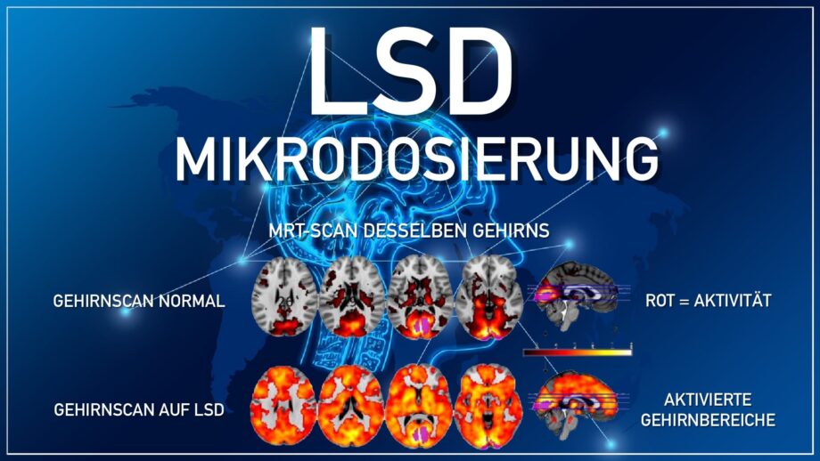 Gehirnscan-LSD-Mikrodosierung